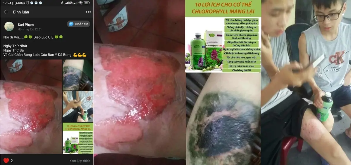 Hỏi đáp, đánh giá Diệp lục TH Health (Chlorophyll UIE PLUS) có tốt không? 19 Feedback từ khách dùng Diệp lục cho vết bỏng - Vết bỏng nặng, bôi diệp lục TH Health sau 3 ngày đã khô và bong