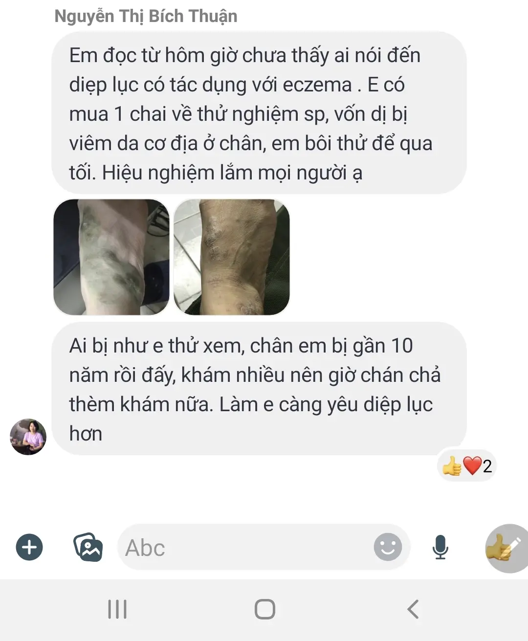 Hỏi đáp, đánh giá Diệp lục TH Health (Chlorophyll UIE PLUS) có tốt không? 20 Người bị Eczema 10 năm không hết, dùng Diệp lục 1 đêm đã thấy có hiệu quả